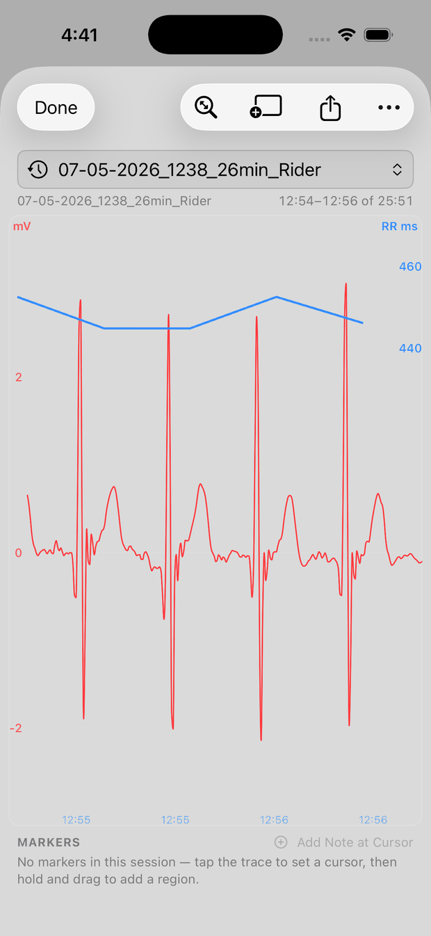ECG zoomed to four heartbeats with the RR trace above, on a light background